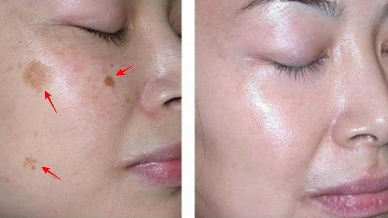 أفضل الكريمات المساعدة على تفتيح البشرة وإزالة البقع البنية من الوجه